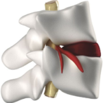 Subluxación vertebral